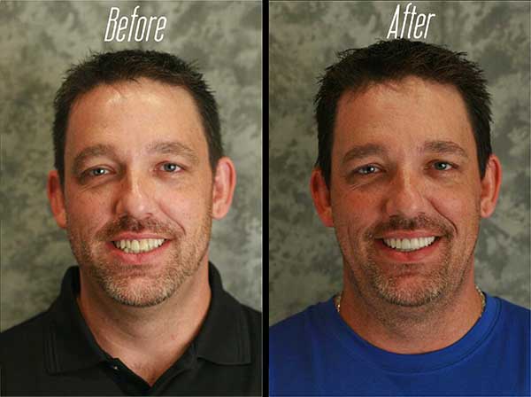 The image displays a before-and-after comparison of a man s facial appearance, with the  before  showing him with a beard and  after  without it.