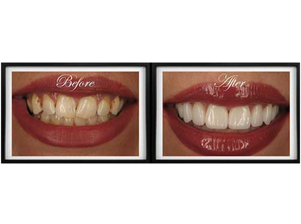 Before and after teeth whitening images with a smiling woman showcasing the transformation of her smile.