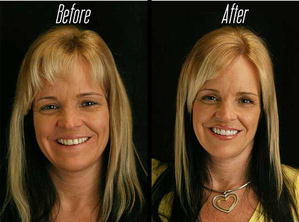 The image shows a before-and-after comparison of facial cosmetic treatments, featuring two photos of the same woman with visible enhancements to her appearance.