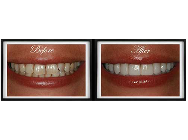 The image shows a before and after view of teeth whitening, with the top photo showing discolored teeth and the bottom photo showing a bright, clean smile after treatment.