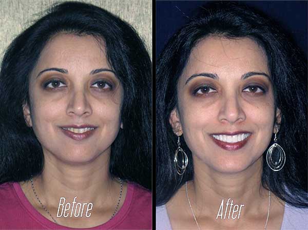 Before and after cosmetic dental work featuring a woman with improved teeth and smile.