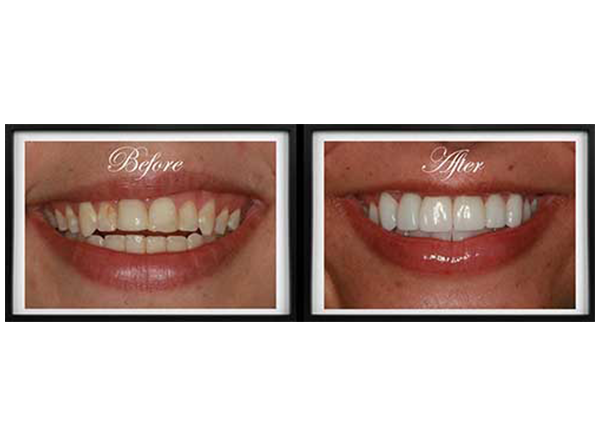 The image shows a before-and-after comparison of a teeth whitening treatment, with the top half showing a person s smile before the procedure and the bottom half showing the same person s smile after the treatment.