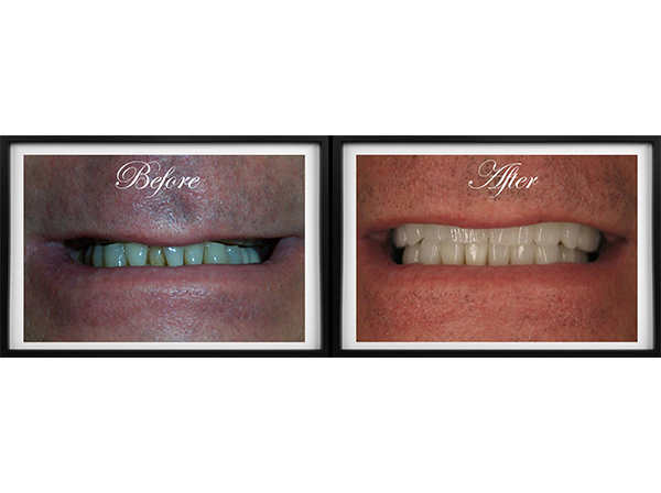 The image shows a side-by-side comparison of a person s teeth before and after cosmetic dental treatment, with the after photo showing a brighter smile.