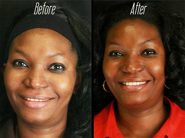 The image displays a side-by-side comparison of a person s face before and after cosmetic treatment, showcasing the results of skin care or enhancement.