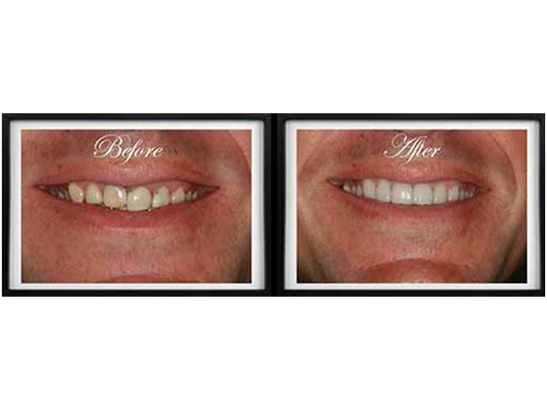 The image shows a side-by-side comparison of a person s teeth before and after dental treatment, with the words  Before  and  After  visible in the respective images.
