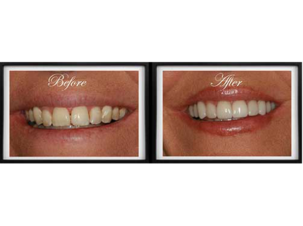The image displays a person s teeth transformation before and after cosmetic dental work, showcasing the results of a smile makeover.