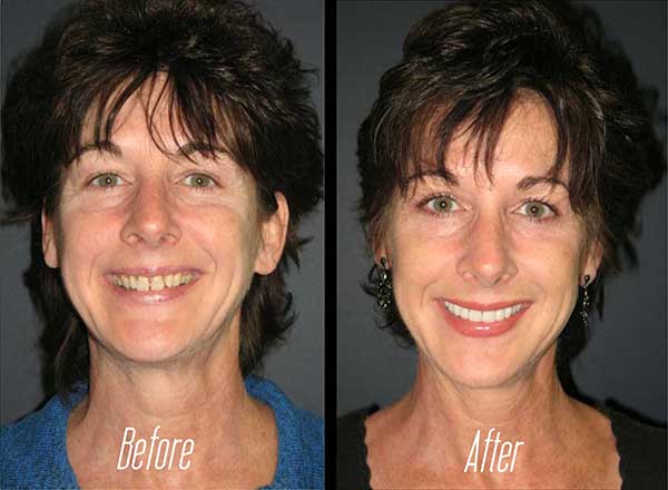 A split-screen image comparing a person s appearance before and after cosmetic treatment, showcasing the results of a facial procedure.