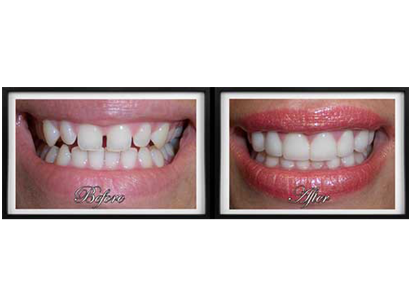 The image displays a side-by-side comparison of a person s teeth before and after dental treatment, showcasing the results of cosmetic dentistry.