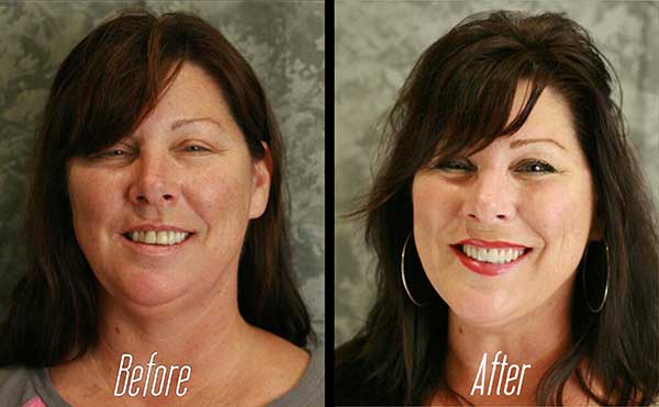 The image shows a woman before and after cosmetic treatment, specifically a facelift, with the text  BEFORE  and  AFTER  visible.
