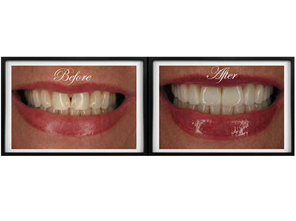 The image displays a before-and-after comparison of dental work, showcasing the transformation from a smile with visible discoloration to one with clean and bright teeth.