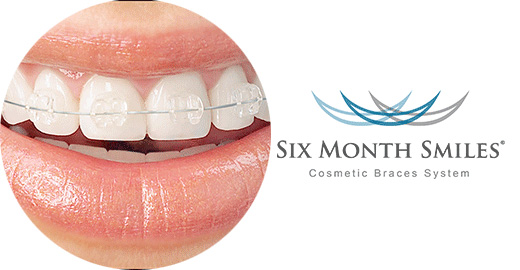 The image features a close-up of an individual s smile, showcasing their teeth and lips, with text overlaying the top left corner that reads  Six Month Smiles  and a logo for  Cosmetic Dental Services.