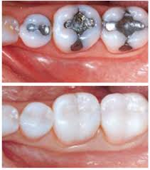 The image shows a close-up of a person s teeth with visible fillings and crowns, highlighting dental work and the natural tooth structure.