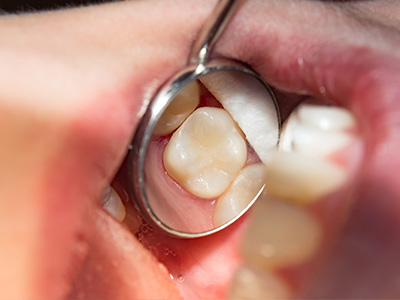 Alt text  A close-up image of a person s mouth with an open tooth, showcasing the interior of the mouth and a dental instrument.